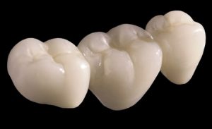 Quy trình làm răng sứ toàn sứ như thế nào ?