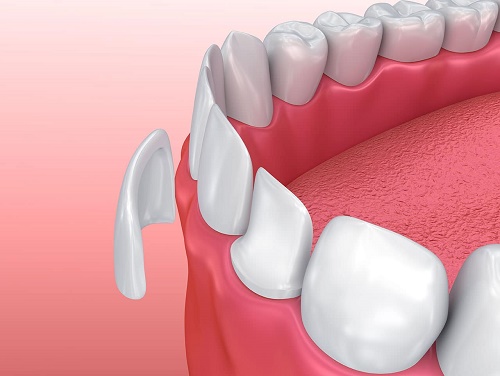 Mặt dán răng sứ Veneer 3D 2 Mặt dán răng sứ Veneer 3D 2