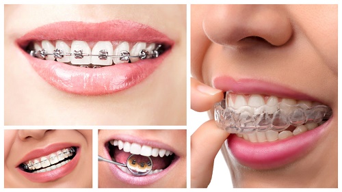 Quy trình niềng răng mặt lưỡi 2