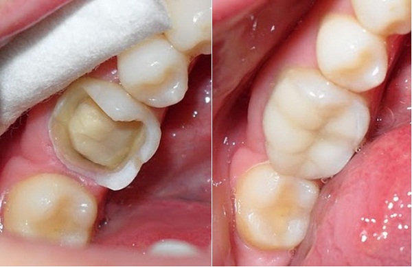 Trám răng có đau không? 2