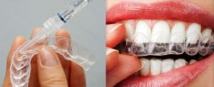 Tẩy trắng răng tại nhà có an toàn
