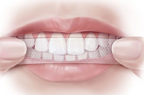 Tẩy trắng răng tại nhà có an toàn không ? 2