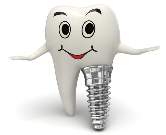 Cách chăm sóc răng sau khi cấy Implant 1