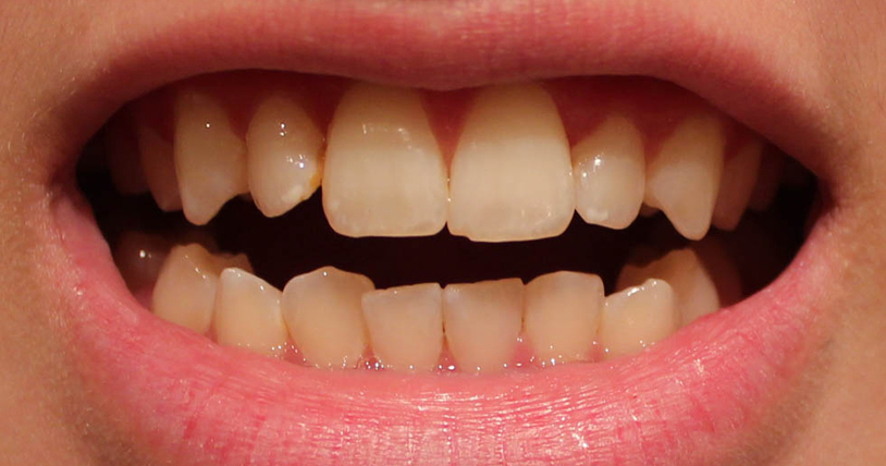 Răng bị xỉn màu có nên đi tẩy trắng răng không? 1