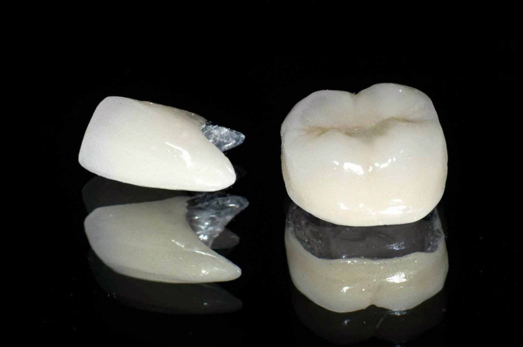 Độ bền của răng sứ thẩm mỹ là bao lâu? 4 Độ bền của răng sứ thẩm mỹ là bao lâu? 4