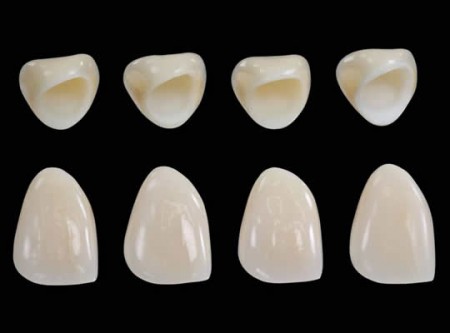 Độ bền của răng sứ thẩm mỹ là bao lâu? 5