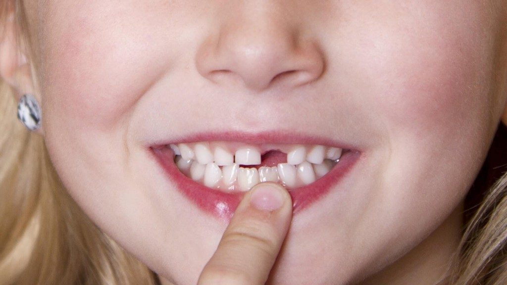 Cắm Implant răng cửa như thế nào? 1