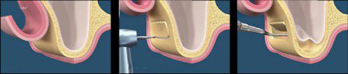 Nâng xoang hàm trong cấy ghép Implant 1