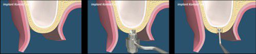 Nâng xoang hàm trong cấy ghép Implant 2