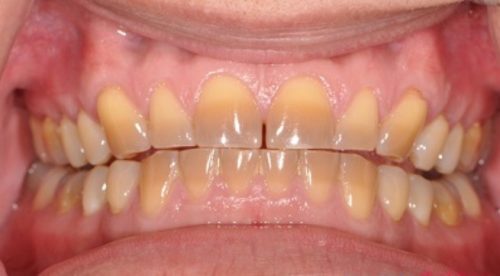 Hiện tượng răng bị ê buốt sau khi tẩy trắng có sao không? 1