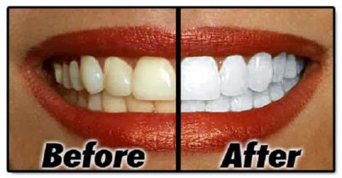 Trường hợp răng bị vàng có tẩy trắng được không? 3