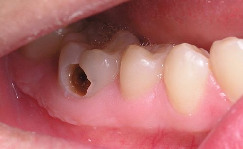 Tẩy trắng răng cho răng sâu có được không bác sĩ? 1