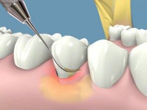 Tẩy trắng răng duy trì được bao lâu? 2