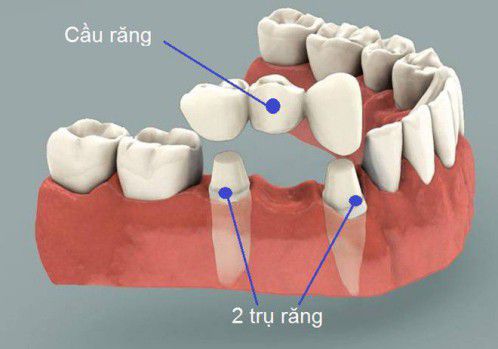 Gãy răng cửa có nên trồng răng không? Trồng răng cửa có đau không? 1