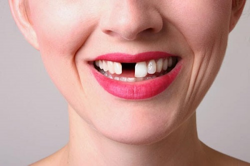 Trồng răng giả cố định giá bao nhiêu tiền? 1 Trồng răng giả cố định giá bao nhiêu tiền? 1