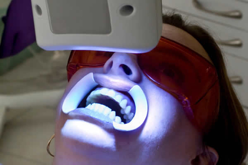 Tẩy trắng răng bằng Laser có hại không? 1