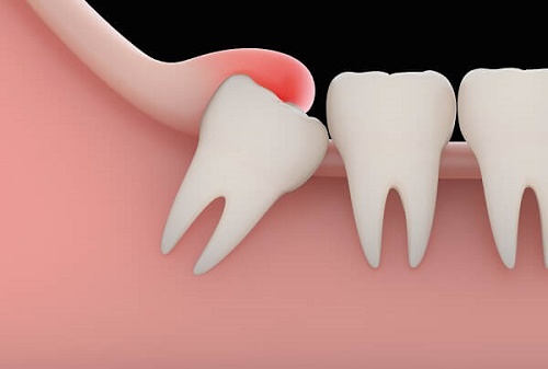 Mọc răng khôn đau trong bao lâu? 3