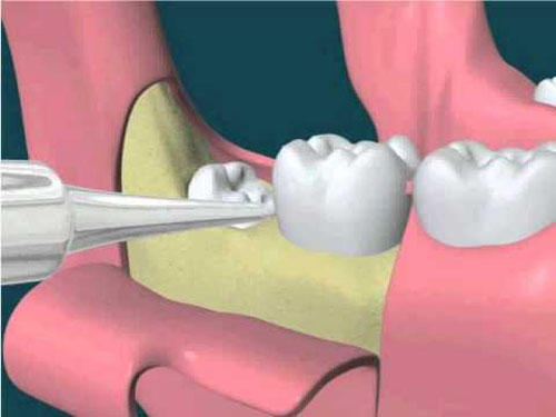 Phương pháp nhổ răng khôn không đau 4