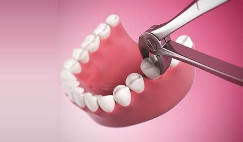 Phương pháp nhổ răng khôn không đau 5