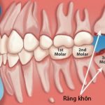 Răng khôn bao giờ mọc - Cách xử lý