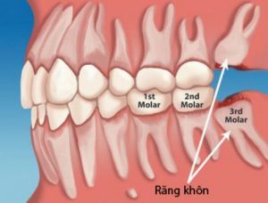 Răng khôn bao giờ mọc - Cách xử lý