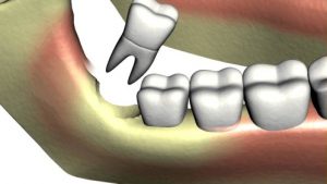 Răng khôn bao giờ mọc - Cách xử lý 3