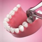 Khi răng khôn bị sâu có nên nhổ không?