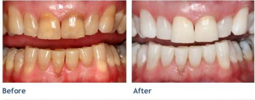 5 sự thật về lý do tẩy trắng răng được nhiều người chọn lựa 3