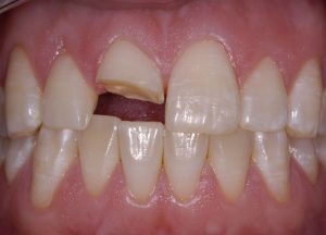 Bọc răng sứ cho răng hàm đẹp an toàn 1