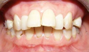 Bọc răng sứ cho răng hô nhanh chóng hiệu quả 1