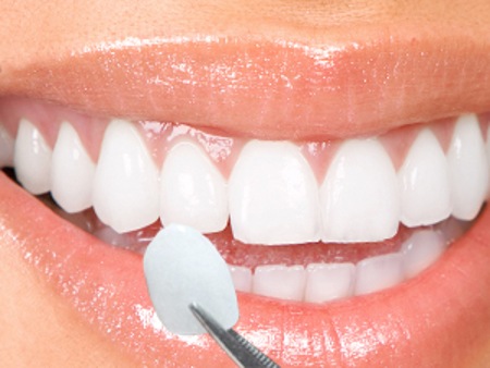Bọc răng sứ cho răng khấp khểnh có đều đẹp không? 1