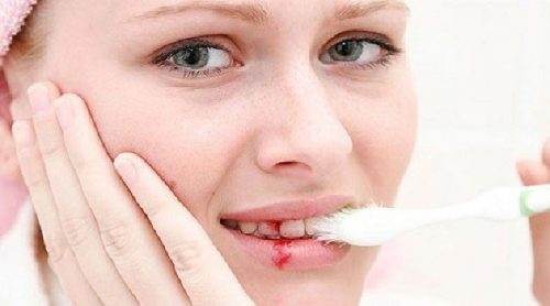 Chảy máu chân răng khi đánh răng phải làm sao? 1