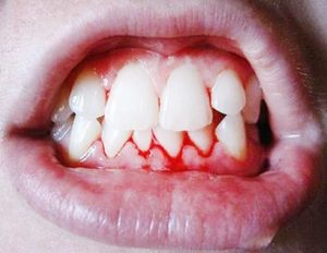 Chảy máu chân răng là biểu hiện của bệnh gì sắp đến? 1