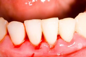 Chảy máu chân răng là thiếu chất gì? Bạn có biết 1