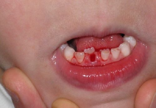 Chảy máu chân răng trẻ em xử lý ra sao? 2