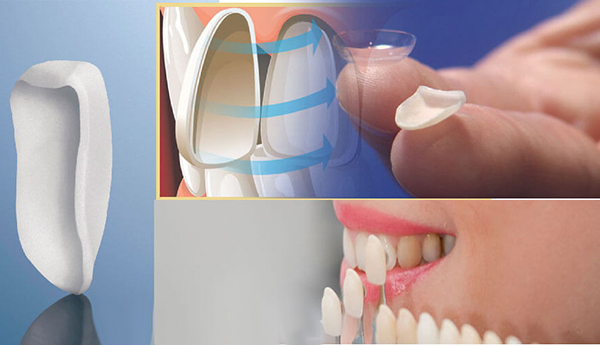 Răng đã lấy tủy có nên bọc răng sứ? 3