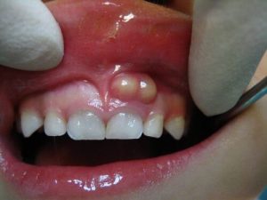 Cách điều trị viêm chân răng có mủ 1