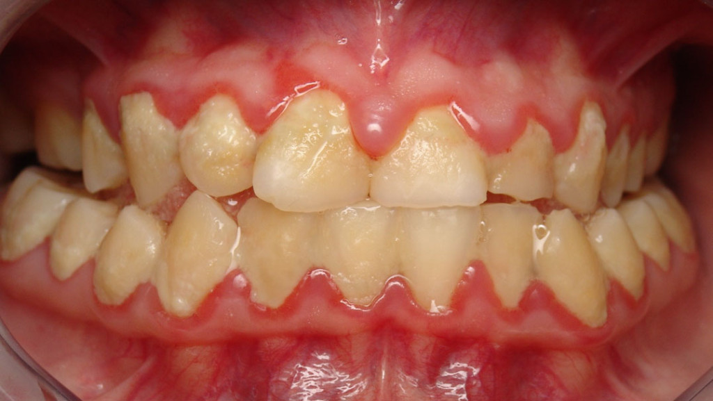 Cách điều trị viêm chân răng có mủ 2