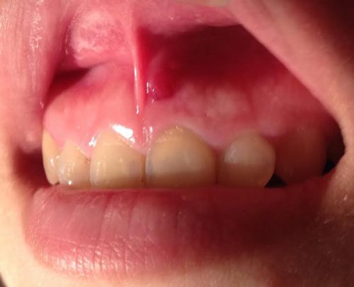 Hình ảnh Mủ ở bệnh nhân mắc viêm chân răng