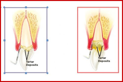 Bị viêm chân răng có nguy hiểm không? 2