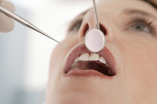 Viêm lợi trùm răng khôn thường xuất hiện khi nào? 3