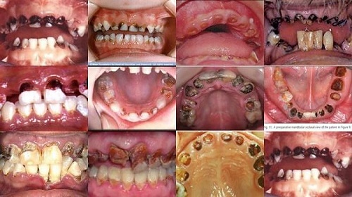 Bé bị sâu răng có nên hàn răng cho bé không? 3