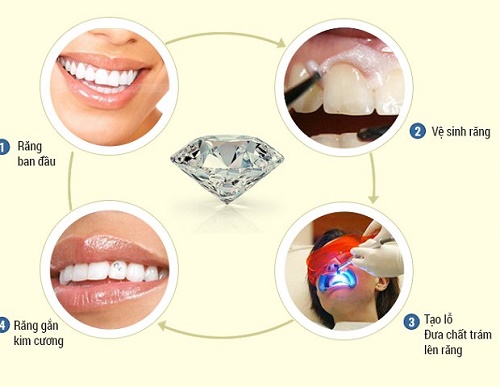 Thẩm mỹ đính đá vào răng có hại không vậy? 2