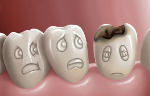 Nhổ răng sâu hết bao nhiêu tiền vậy? 1