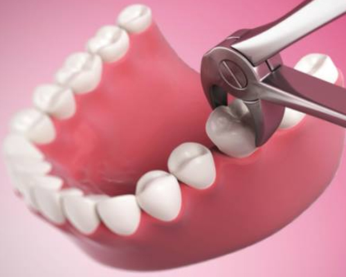 Nhổ răng hàm có ảnh hưởng gì không 3