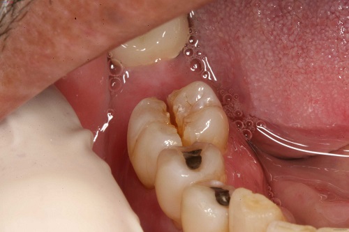 Nhổ răng hàm có nguy hiểm không mọi người? 1