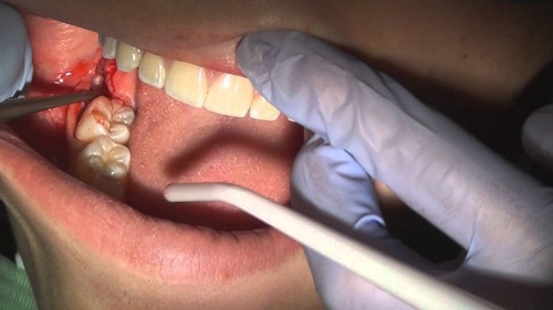 Nhổ răng có ảnh hưởng gì không? Tìm hiểu thêm 1