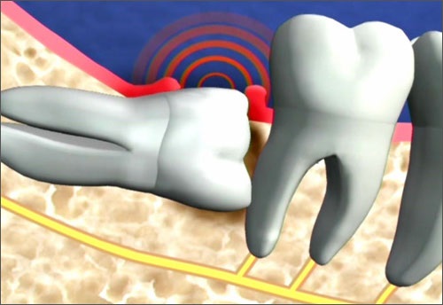 Nhổ răng có ảnh hưởng gì không? Tìm hiểu thêm 2