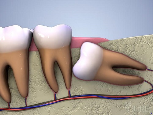 Nhổ răng có ảnh hưởng gì không? Tìm hiểu thêm 3
