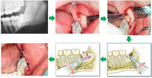Nhổ răng khôn hàm dưới có nhanh lành không? 2